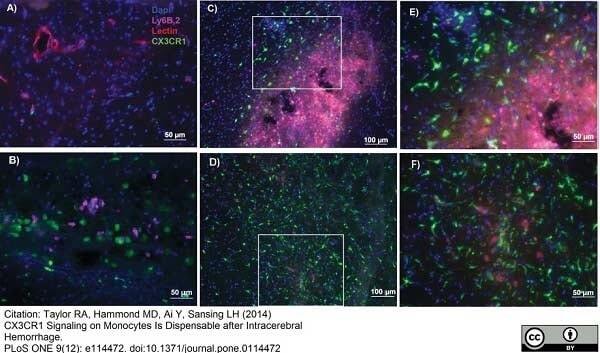 <strong>Published customer image:</strong> <br>Rat anti Mouse Ly-6B.2 antibody, clone 7/4 (<strong>MCA771GA</strong>) used for the detection of Ly-6B.2 positive cells by immunofluorescence.<br><strong>Image caption:</strong><br>CX3CR1+, Ly6Clo monocytes are present in perihematomal brain in CX3CR1-null BM chimeras. Mice were injected intracardially with 150&mu;g tomato lectin to delineate vasculature. Brain slices were stained with Ly6B.2 antibody to differentiate Ly6Chi monocytes and neutrophils from Ly6Clo CX3CR1+ monocytes and Dapi nuclear stain. A) Intracardiac injection of lectin stains vasculature in the brain– 20x. B) At 72 hours after ICH, distinct subsets of amoeboid Ly6B.2+ (Ly6Chi monocytes or neutrophils) and GFP+ (CX3CR1+) monocytes are seen in the perihematomal region. 20x. C) At 7 days after ICH, amoeboid, Ly6B.2−,CX3CR1+ cells are seen in the brain parenchyma surrounding the ICH cavity. The center of the ICH cavity is filled with Ly6B.2+ (Ly6Chi) monocytes or neutrophils. Tomato lectin staining is also seen in the center of the ICH cavity, most likely due to blood brain barrier breakdown at this time point leading to nonspecific lectin staining of myeloid cells. 10x. White box indicates the inset shown in panel E. D) At 14 days, amoeboid, CX3CR1+ cells can still be seen in the perihematomal region, however more CX3CR1+ cells have a ramified morphology. No Ly6B.2+ (Ly6Chi monocytes or neutrophils) cells are found. Overall blood-brain barrier disruption is improved leading to less lectin staining in the cavity, although there remain some lectin+ cells (CX3CR1+ monocytes and CX3CR1− microglia). 10x. White box indicates inset shown in panel F. E) 20x image of panel C – perihematomal region 7 days after ICH F) 20x image of panel D – perihematomal region 14 days after ICH. Blue – Dapi, GFP – CX3CR1, Red – Tomato lectin, Pink – Ly6B.2, n = 5.<br><br>From: Taylor RA, Hammond MD, Ai Y, Sansing LH (2014)<br>CX3CR1 Signaling on Monocytes Is Dispensable after Intracerebral Hemorrhage.<br><strong><a href="https://www.ncbi.nlm.nih.gov/pubmed/25469644"target="_blank" rel="noopener">PLoS ONE 9(12): e114472</a></strong>.<br>This image is from an open access article distributed under the terms of a <a href="https://creativecommons.org/licenses/by/4.0/"target="_blank" rel="noopener">Creative Commons Attribution License</a>.