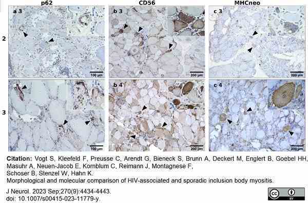 <strong>Published customer image:</strong> <br>Mouse anti Human CD56 antibody, clone ERIC-1 (<strong>MCA591</strong>) used to label CD56 expressing cells in human HIV-associated myosistis samples by immunohistochemistry of cryosections.<br><strong>Image caption:</strong><br>Severity of histopathological changes p62, CD56, MHCneo.<br>Severity levels of histopathological changes: 2 (moderate), 3 (severe). P62 staining shows autophagy with autophagic structures concentrated within the vacuoles in a few fibres (severity level 2, a3) and in multiple fibres (severity level 3, a4). CD56 and neonatal MHC staining show regenerating fibres with increasing numbers for each level of severity (b3-4, c3-4).  <br><br>From: Vogt S, Kleefeld F, Preusse C, Arendt G, Bieneck S, Brunn A, Deckert M, Englert B, Goebel HH, Masuhr A, Neuen-Jacob E, Kornblum C, Reimann J, Montagnese F, Schoser B, Stenzel W, Hahn K.<br>Morphological and molecular comparison of HIV-associated and sporadic inclusion body myositis.<br>J Neurol. 2023 Sep;270(9):4434-43.<br>doi: 10.1007/s00415-023-11779-y.<br>This image is from an open access article distributed under terms of a <a href="https://creativecommons.org/licenses/by/4.0/"target="_blank" rel="noopener">Creative Commons Attribution License</a>.