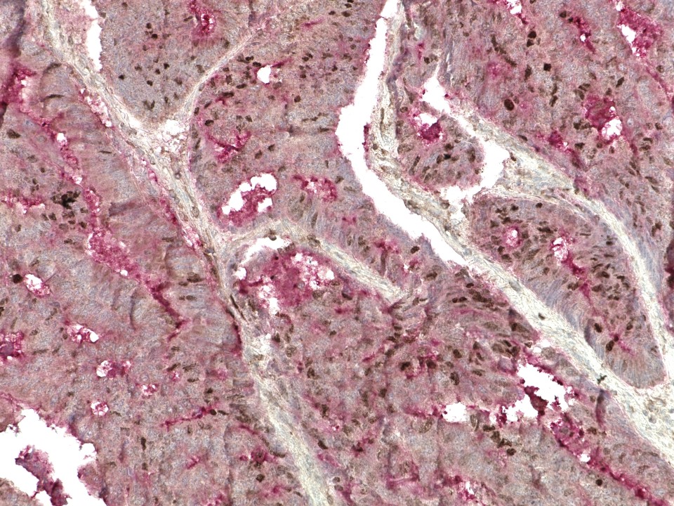 IHC staining of FFPE human colon cancer tissue using rabbit anti-CEA and mouse anti-Ki-67 monoclonal antibodies and Polink DS-MR-Hu A1 Kit detection kit DS201A-6. The brown (mouse anti-Ki67) and red (rabbit anti-CEA) staining indicate positive stain, and blue is the hematoxylin counter stain. It is mounted using a permanent organic mounting medium E37-100.