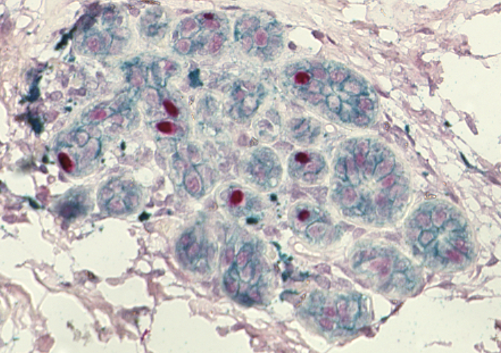 IHC staining of FFPE human breast tissue using rabbit anti-ER and mouse anti-CDH1 monoclonal antibodies and Polink DS-MR-Hu C1 detection kit DS201C-6. The green (mouse anti-CDH1) and red (rabbit anti-ER) staining indicate positive stain, and blue is the hematoxylin counter stain. It is mounted using a permanent organic mounting medium E37-100.