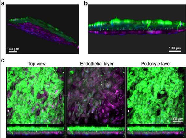 Fluorescence microscopy images of the human kidney Glomerulus Chip established from iPS cell-derived podocytes and primary glomerular endothelial cells. (a) Side and (b) cross-sectional view of 3D reconstructed confocal images of the human Glomerulus Chip showing the iPS cell-derived podocytes and endothelial cells in their respective layers after differentiation and co-culture on opposing sides of the flexible ECM-coated PDMS membrane. (c) Additional immunofluorescence confocal images showing a top view of both cell layers (left), the endothelial cell layer only (middle), and the human iPS cell-derived podocyte layer (right). Scale bars, 100 μm. Figure modified with permission from Reference 5. Human albumin conjugated to Texas Red (p/n 009–0933). 
Figure 6. PMID: 29995874.