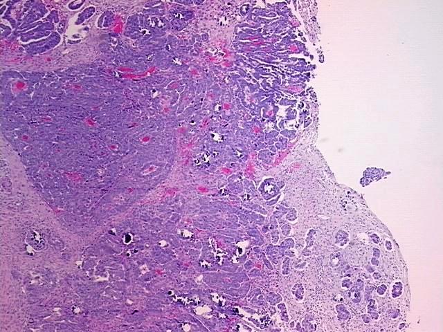 FFPE Tissue Blocks, Ovary