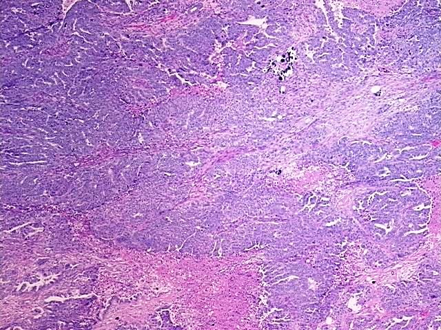 FFPE Tissue Blocks, Ovary