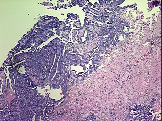 FFPE Tissue Blocks, Ovary