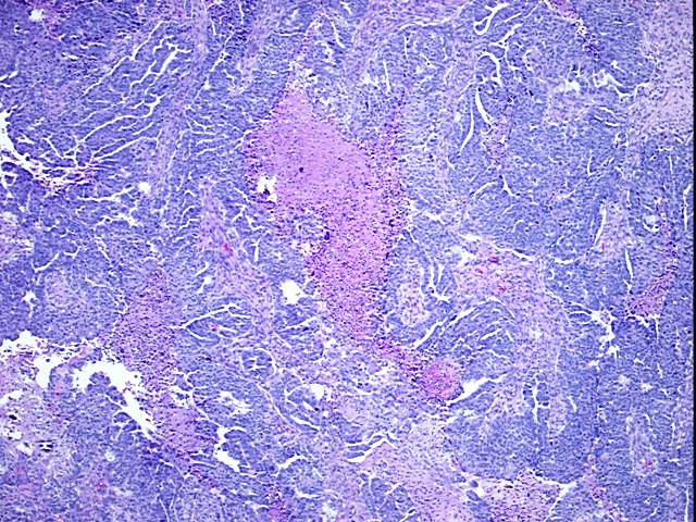 FFPE Tissue Blocks, Ovary