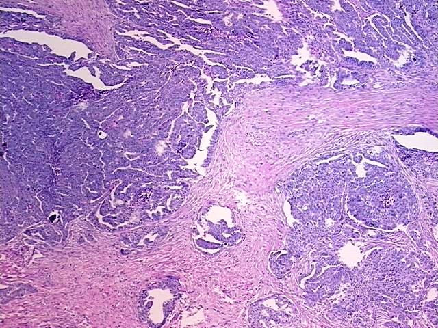 FFPE Tissue Blocks, Ovary