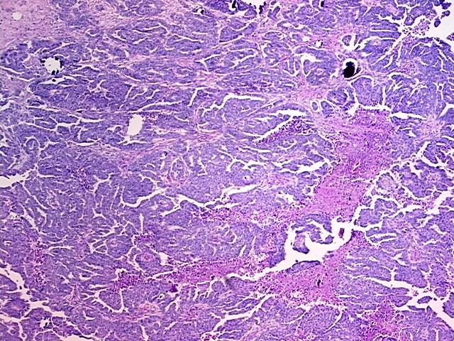 FFPE Tissue Blocks, Ovary