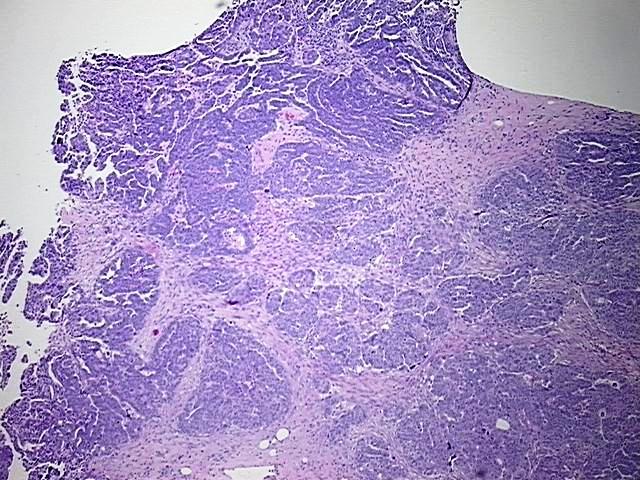FFPE Tissue Blocks, Ovary
