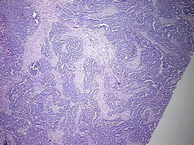 FFPE Tissue Blocks, Ovary