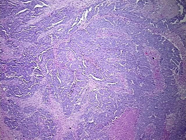 FFPE Tissue Blocks, Ovary