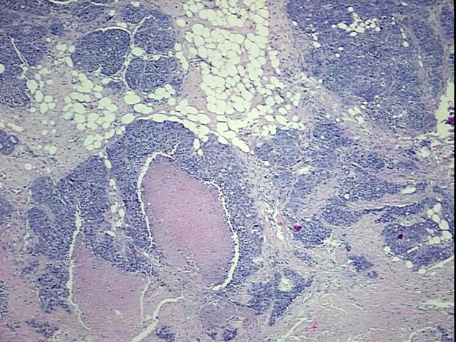 FFPE Tissue Blocks, Ovary: right