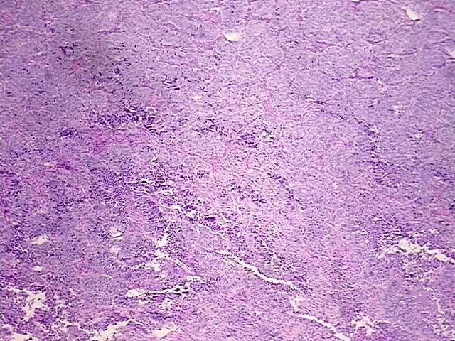 FFPE Tissue Blocks, Ovary: right