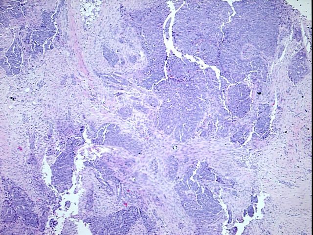 FFPE Tissue Blocks, Ovary
