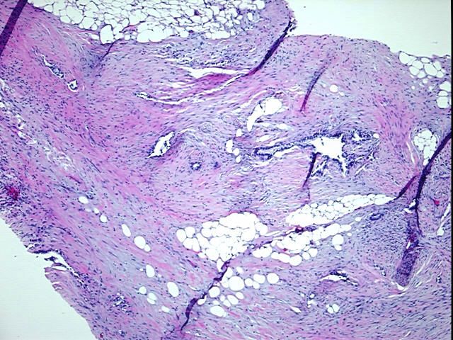 FFPE Tissue Blocks, Ovary
