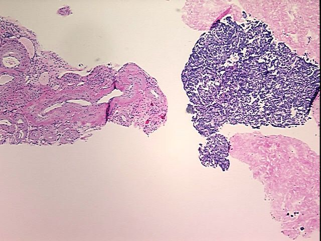 FFPE Tissue Blocks, Ovary: right
