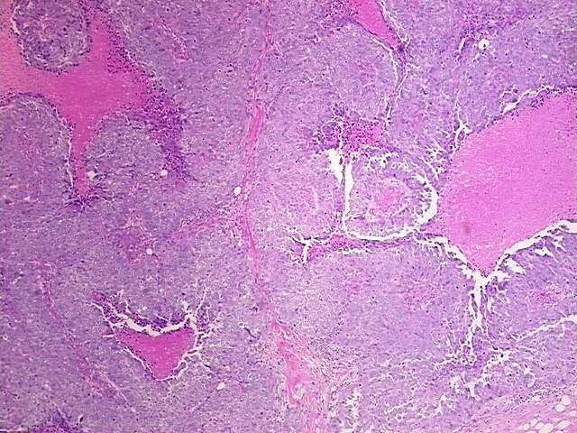 FFPE Tissue Blocks, Ovary: right
