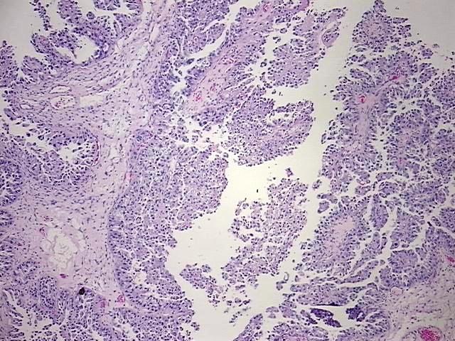 FFPE Tissue Blocks, Adnexa