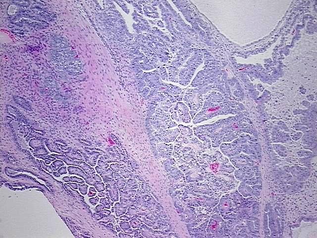 FFPE Tissue Blocks, Ovary: left
