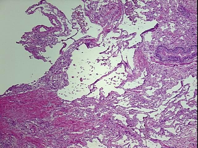 Frozen Tissue Blocks, Lung