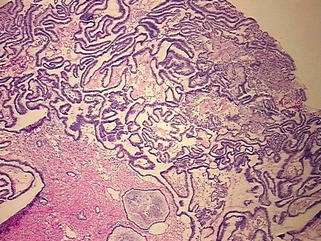 Frozen Tissue Blocks, Ovary: left