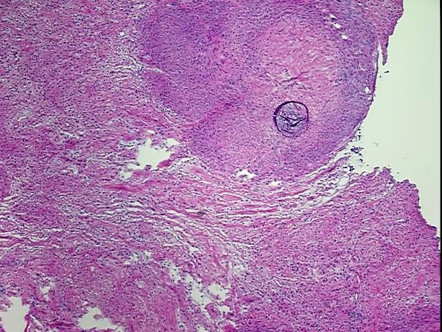 Frozen Tissue Blocks, Myometrium