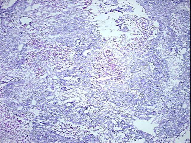 Frozen Tissue Blocks, Ovary