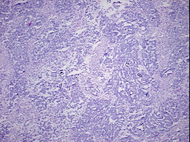 Frozen Tissue Blocks, Ovary