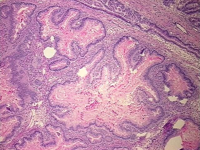Frozen Tissue Blocks, Ovary: left