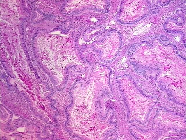Frozen Tissue Blocks, Ovary: left