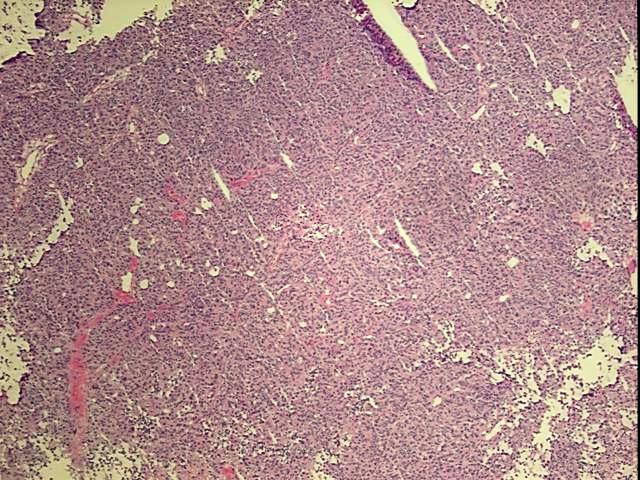 Frozen Tissue Blocks, Ovary