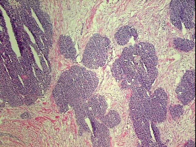 Frozen Tissue Blocks, Ovary