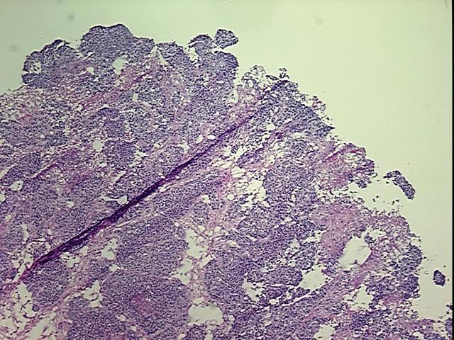 Frozen Tissue Blocks, Ovary: right