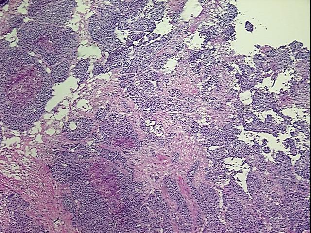 Frozen Tissue Blocks, Ovary: right