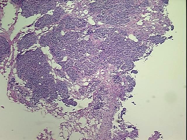 Frozen Tissue Blocks, Ovary: right