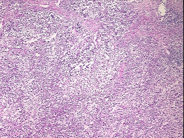 Frozen Tissue Blocks, Kidney