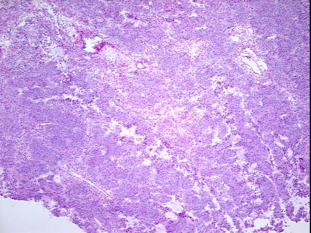 Frozen Tissue Blocks, Ovary: right