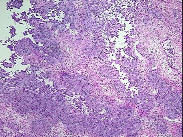 Frozen Tissue Blocks, Ovary: right
