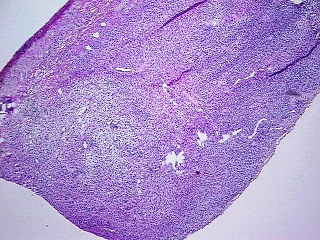 Frozen Tissue Blocks, Ovary: left