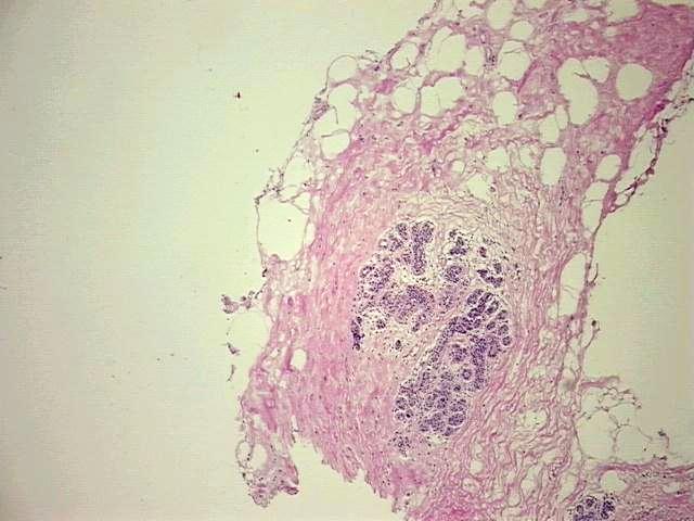 Frozen Tissue Blocks, Breast