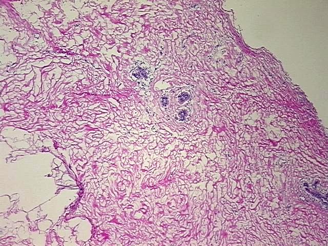 Frozen Tissue Blocks, Breast, left