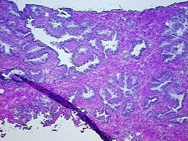 Frozen Tissue Blocks, Prostate