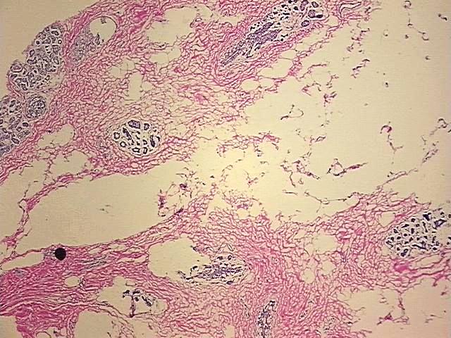 Frozen Tissue Blocks, Breast