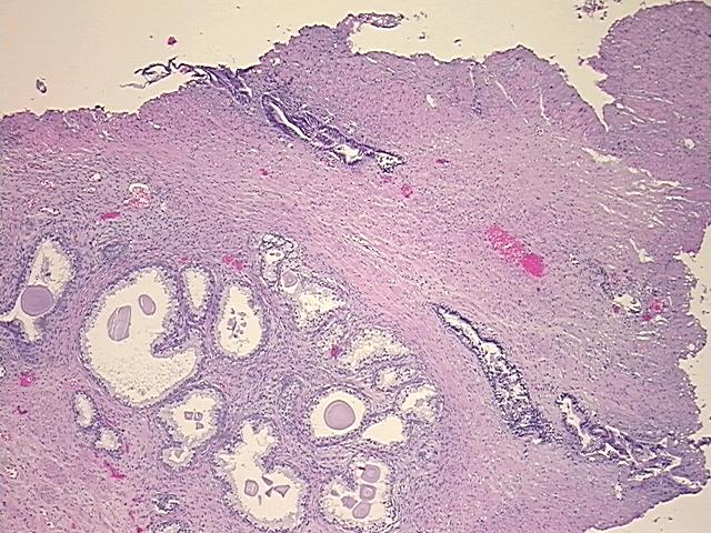 Tissue FFPE Sections, Prostate