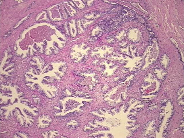 Tissue Sections (5x5um), FFPE; Prostate; Hyperplasia of