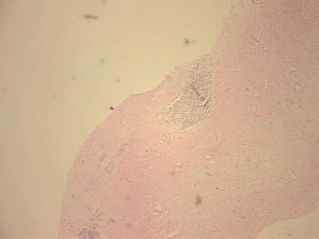Tissue FFPE Sections, Breast