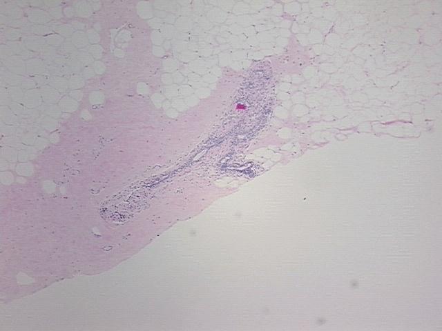 Tissue FFPE Sections, Breast