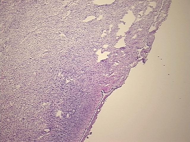Frozen Tissue Sections, Endometriotic tissue
