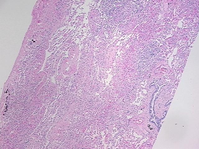 Tissue FFPE Sections, Lung