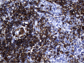 CD20 in Human Lymphoma tissue stained with UM800009