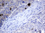 Adenocarcinoma of Human colon tissue stained with anti-MAGEA3 mouse monoclonal antibody (TA800828)